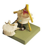 Central Disc Herniation Model